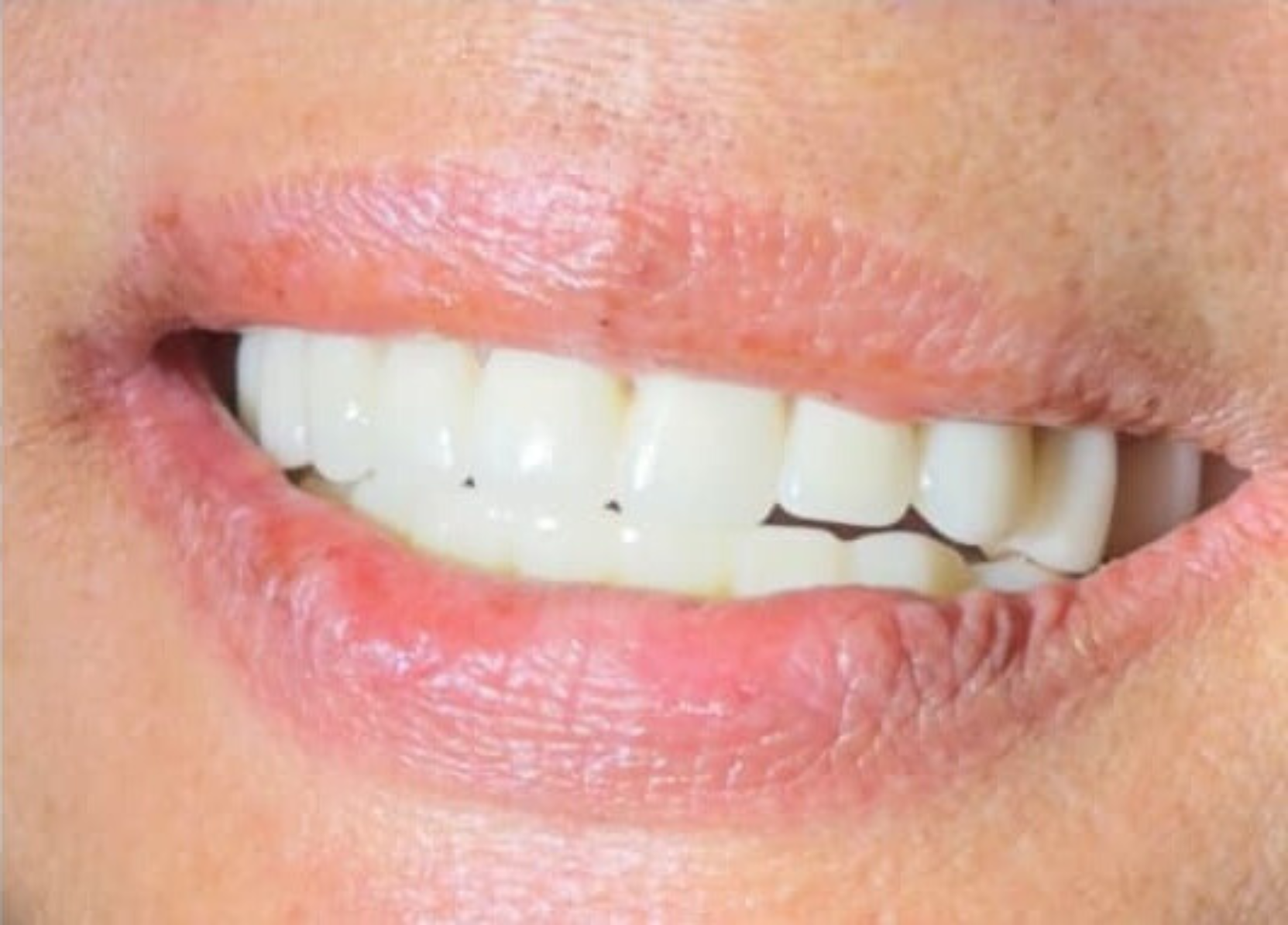 Same patient's new smile the same day after Smile in a Day full-arch implants — full, natural-looking teeth