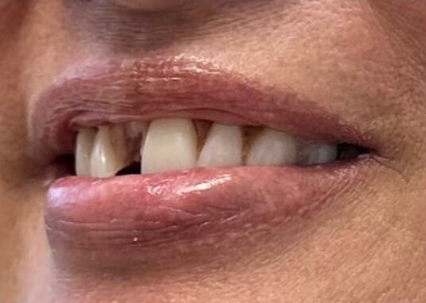 Patient's smile before Smile in a Day full-arch implant treatment — worn and gapped teeth