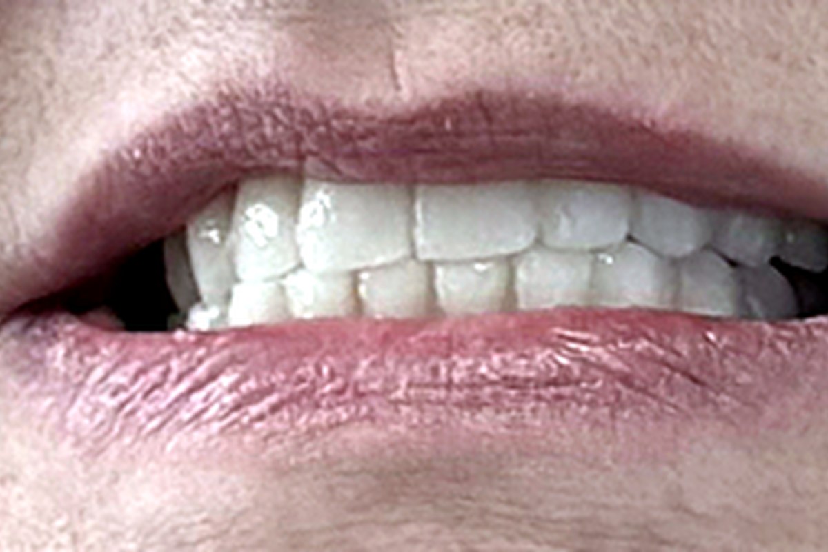 Same patient after full-arch dental implant treatment by Dr. Athari