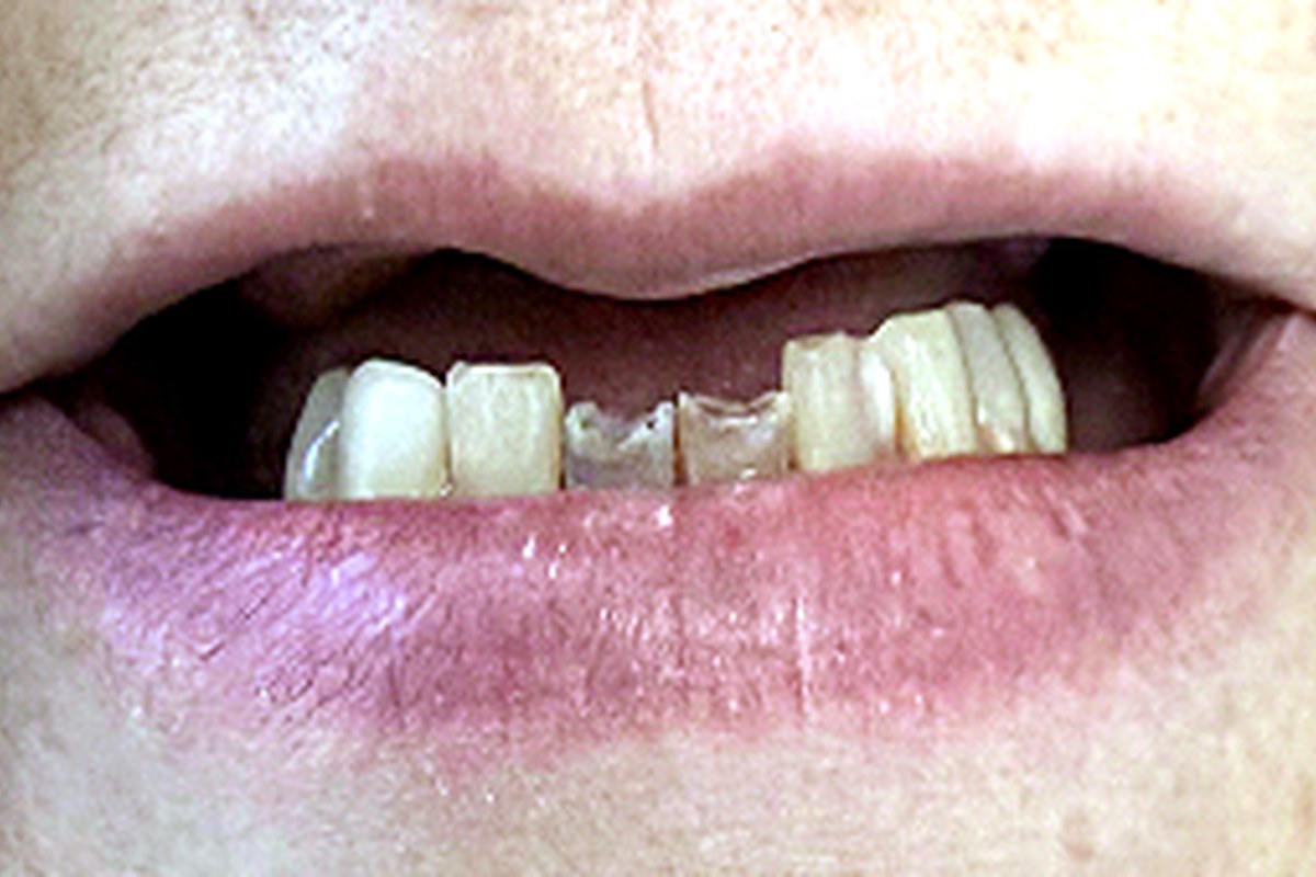 Patient before full-arch dental implant treatment