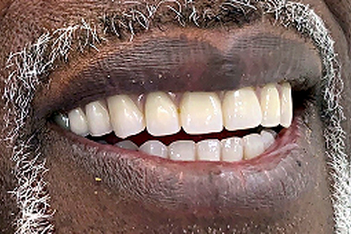 Same patient after full-arch dental implant treatment by Dr. Athari