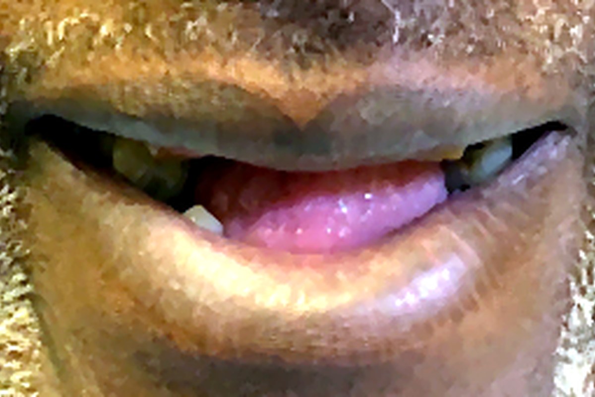 Patient before full-arch dental implant treatment