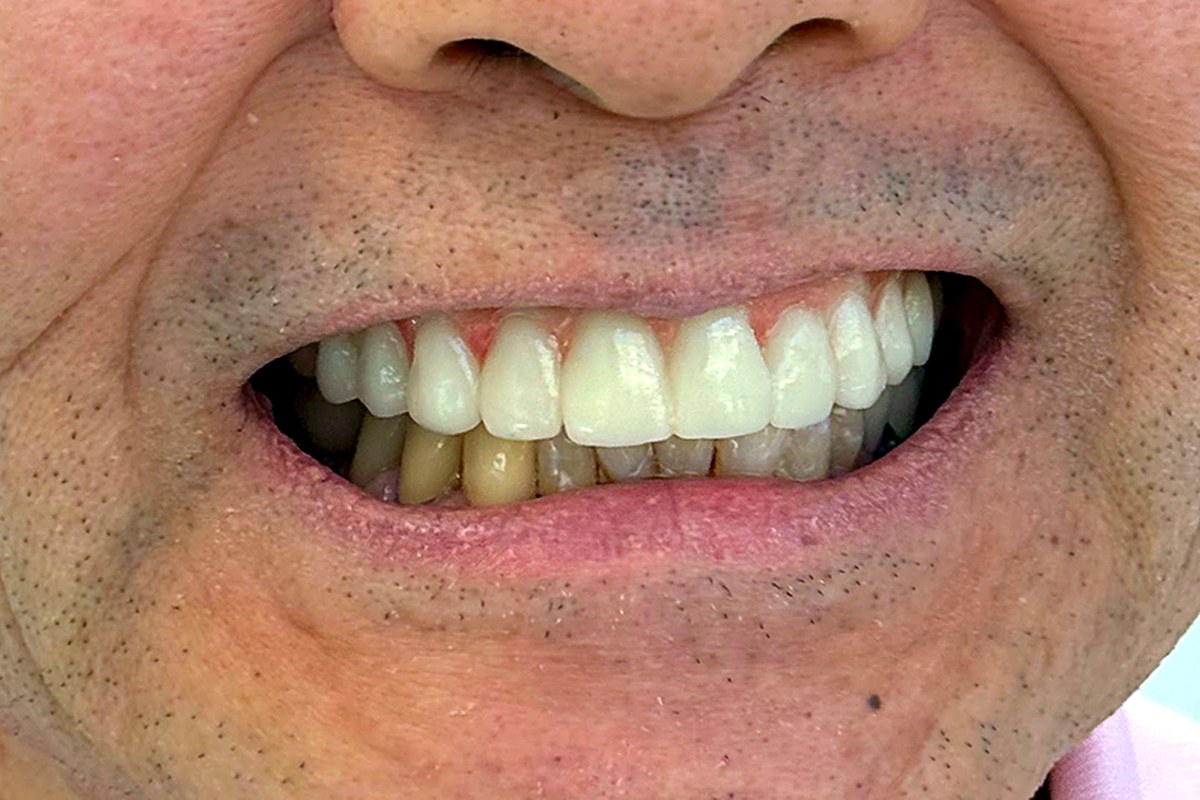Patient after Cosmetic Dentistry treatment by Dr. Athari