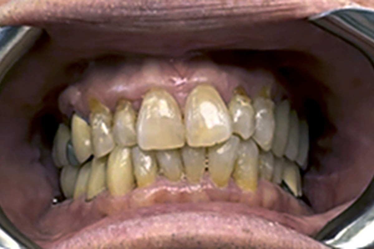 Patient before Cosmetic Dentistry treatment