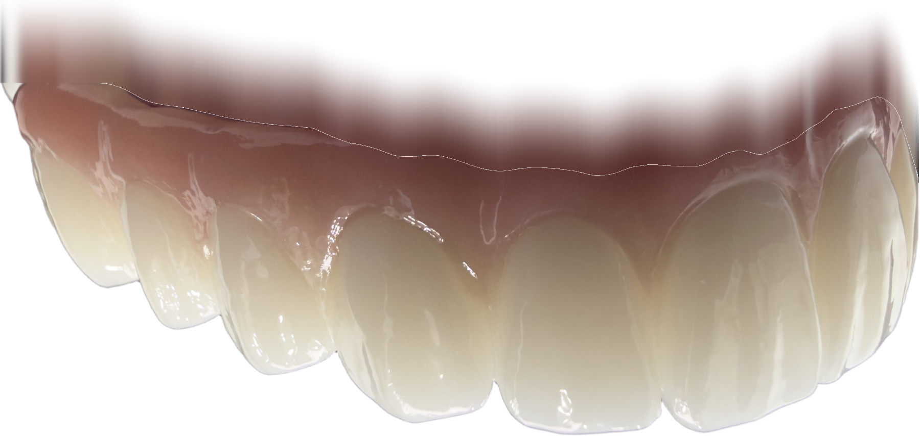 Close-up of a full-arch zirconia implant bridge crafted for a Pleasant-Smiles patient